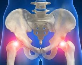 causas de artrosis de la articulación de la cadera