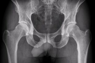 opciones para diagnosticar la artrosis de la articulación de la cadera