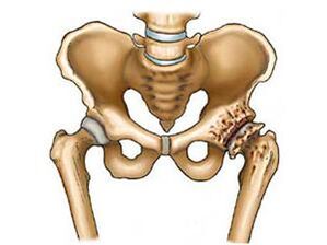 ¿Qué es la artrosis de la articulación de la cadera 