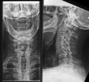 Radiografía de la columna cervical un método para diagnosticar la osteocondrosis