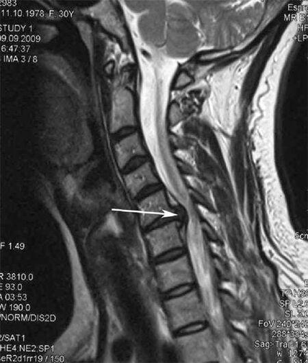 El daño de la médula espinal desencadena el dolor de cuello