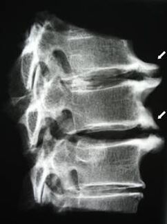 Los osteofitos de la columna cervical causan dolor de cuello. 