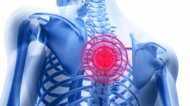 El dolor de espalda puede estar asociado con una hernia de disco. 