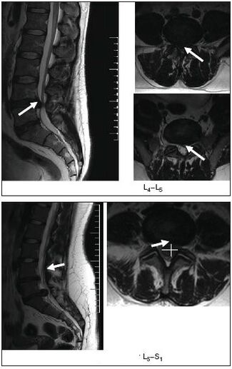 Imagen de resonancia magnética del disco herniado de la columna vertebral