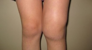 La deformación de la rodilla
