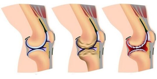 una articulación sana y dolor en la destrucción de la articulación de la rodilla