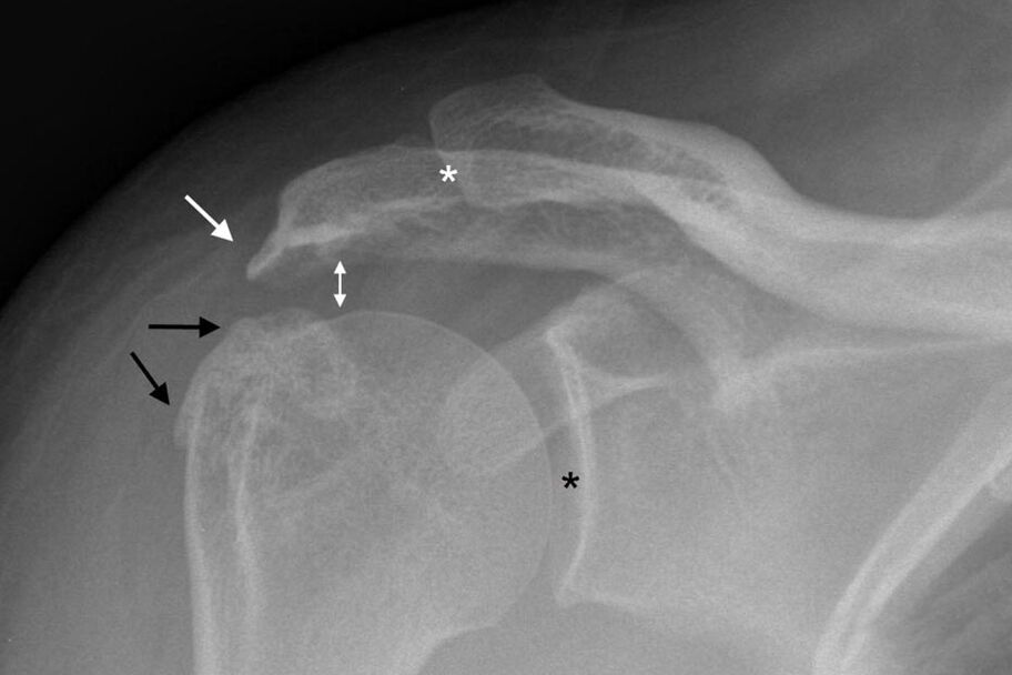 artrosis de la articulación del hombro en la radiografía