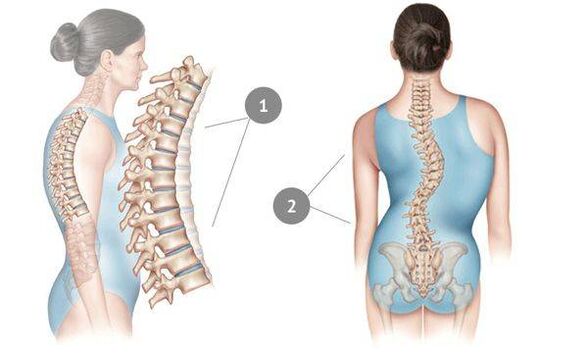 curvatura espinal como causa de la osteocondrosis torácica