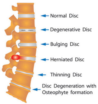 diversos daños en el disco de la columna vertebral