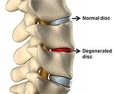 el disco normal de la columna vertebral, disco dañado